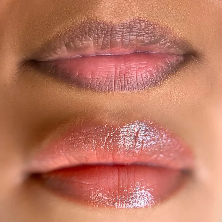 Lip neutralisation before and after — real client work