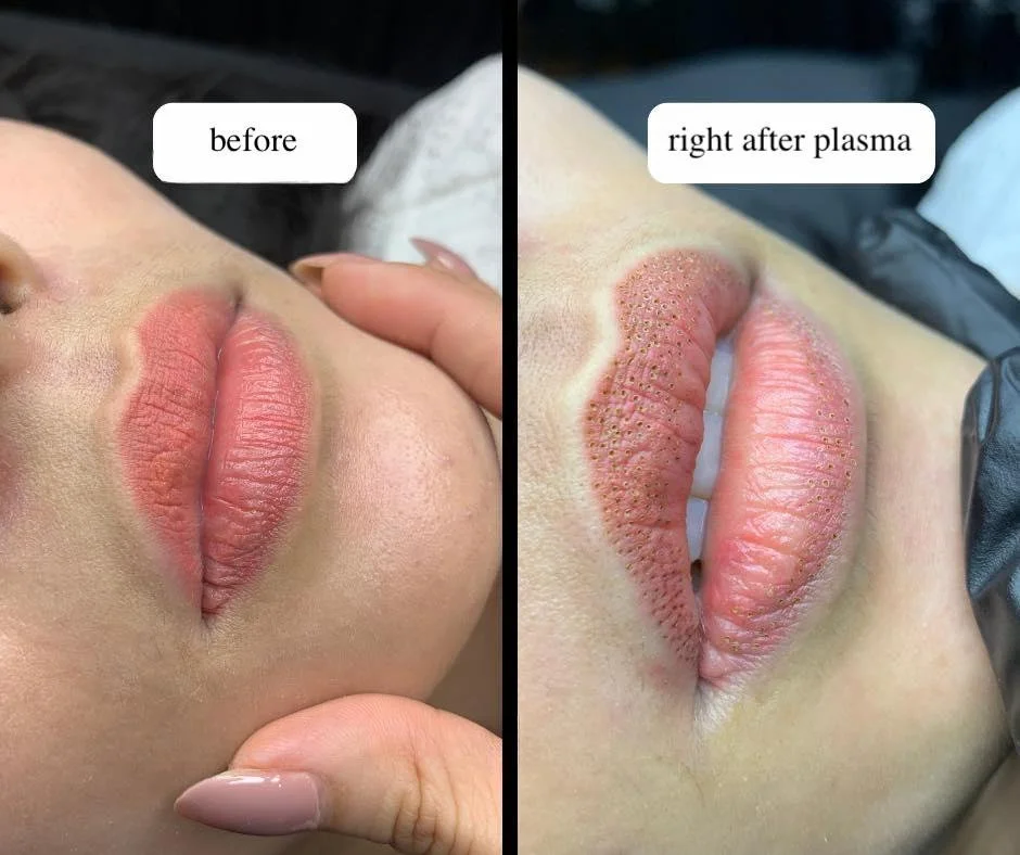 Lips before and immediately after plasma fibroblast treatment